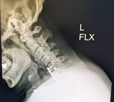 Name:  Neck X-Ray, L-Flex, Jun 2022 - cropped.jpg
Views: 546
Size:  30.2 KB